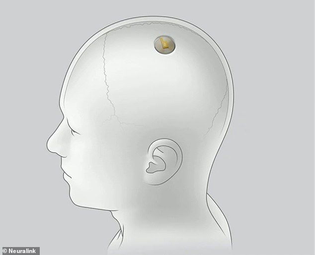 马斯克大脑芯片引伦理担忧动物身上实验被批2.jpg